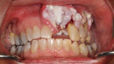 صورة 4 علامات تحذيرية لسرطان الفم